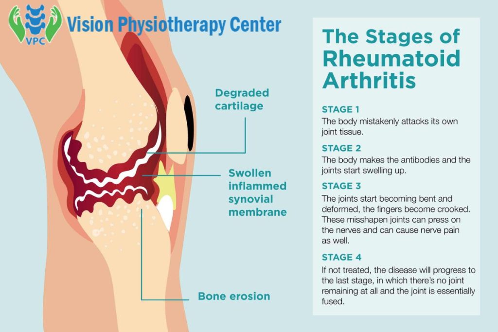 How do I know if I have rheumatoid arthritis