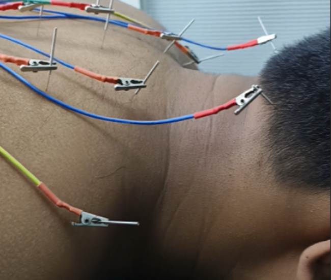 acupuncture
