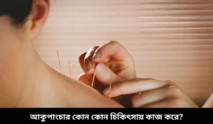 আকুপাংচার কোন কোন চিকিৎসায় কাজ করে