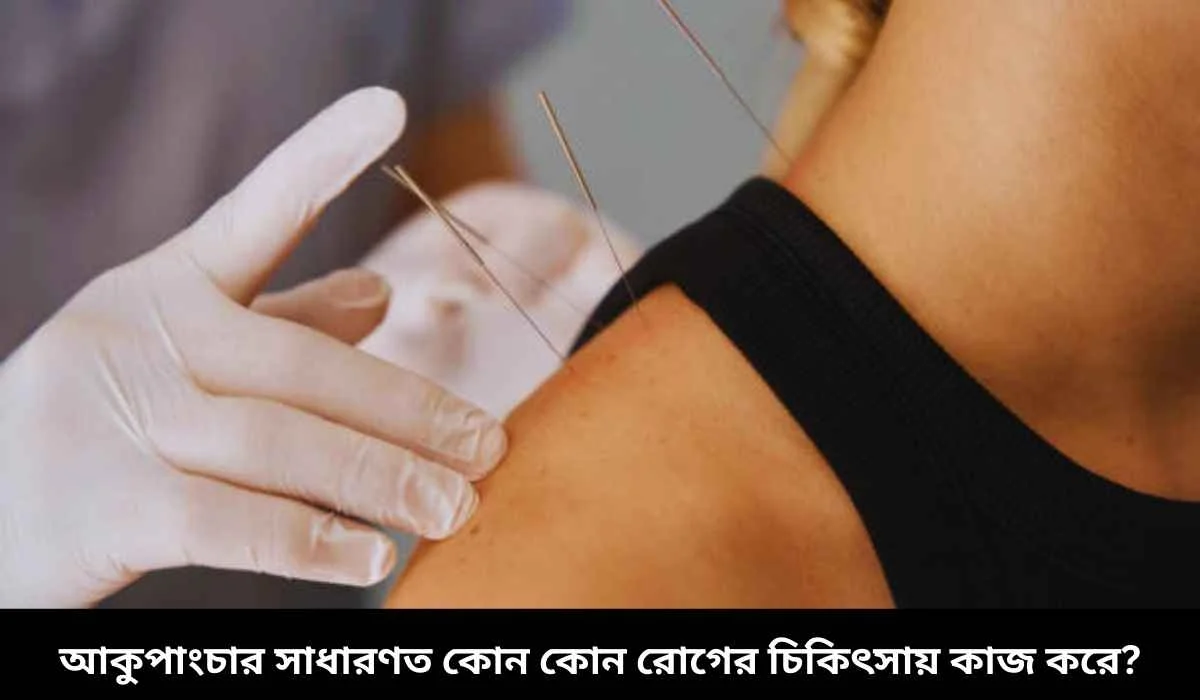 আকুপাংচার সাধারণত কোন কোন রোগের চিকিৎসায় কাজ করে