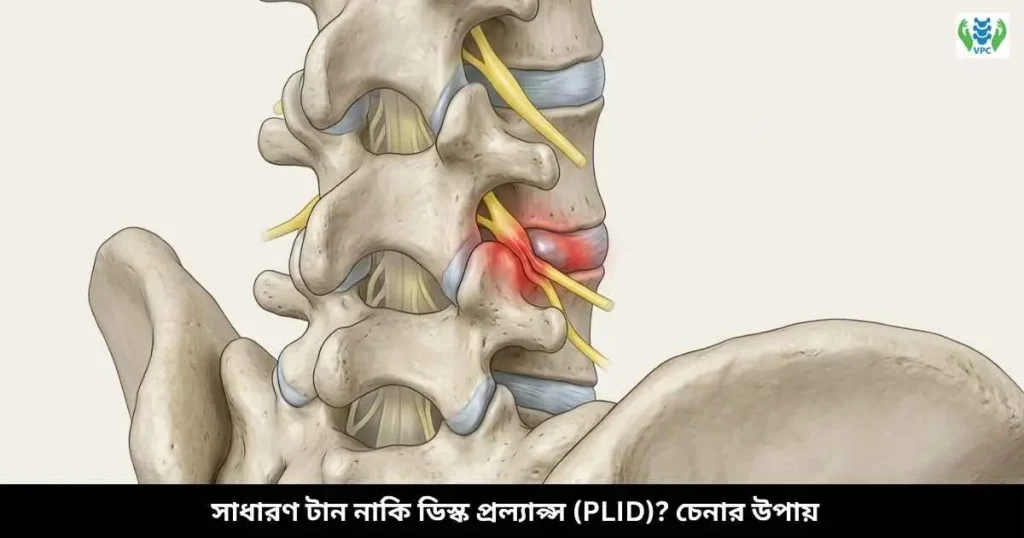 সাধারণ টান নাকি ডিস্ক প্রল্যাপ্স (PLID) চেনার উপায়