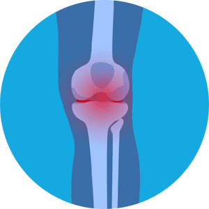 Rheumatoid-Arthritis