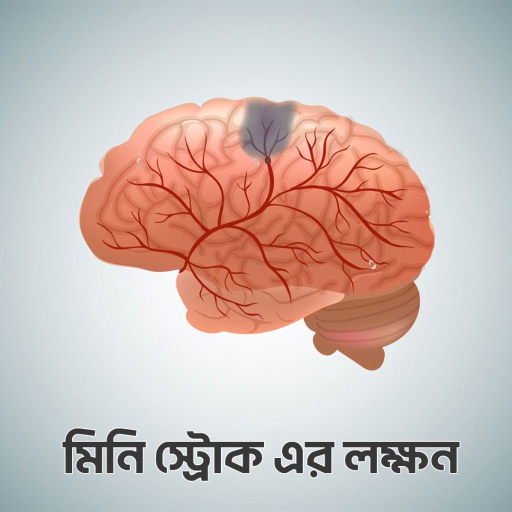 মিনি স্ট্রোকের লক্ষণ