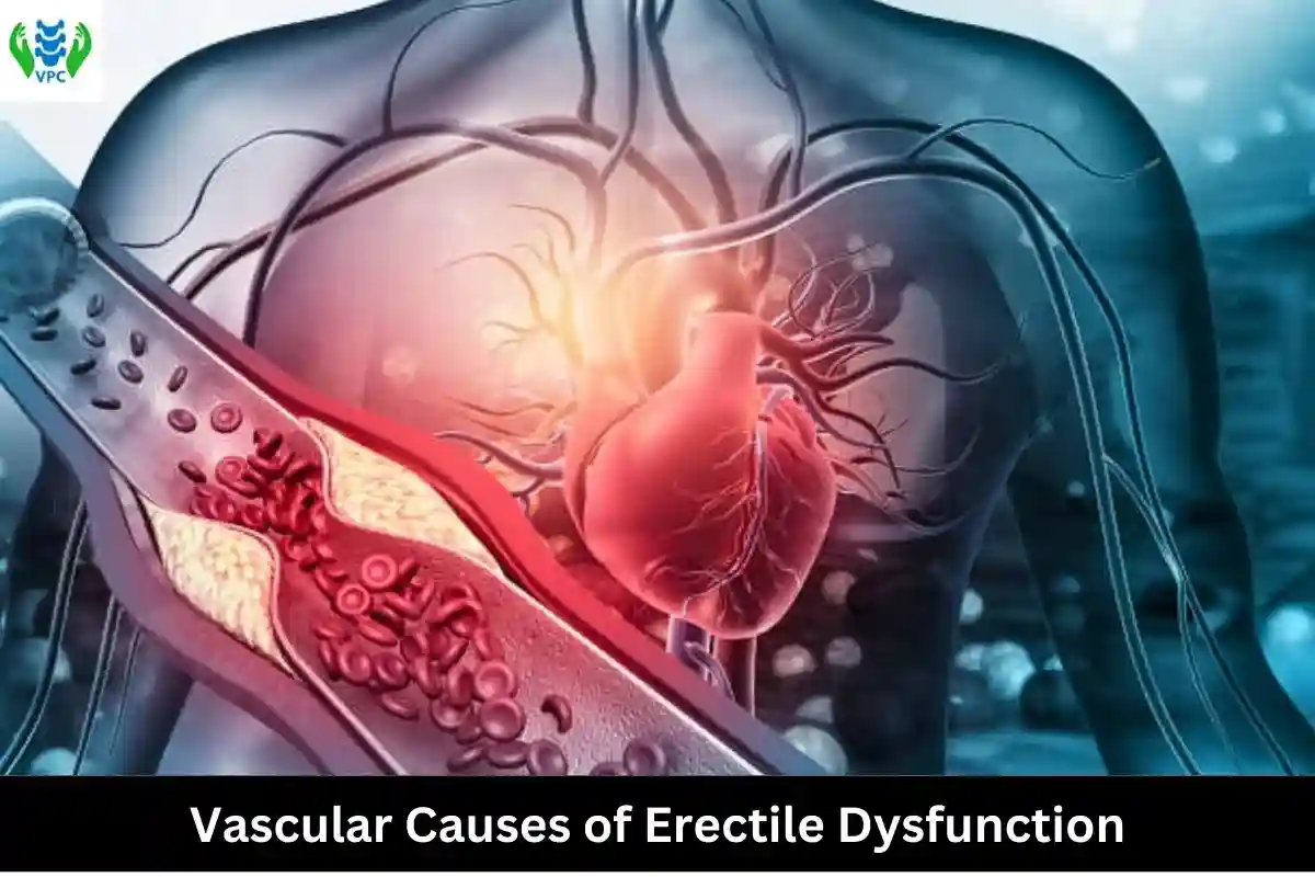 Vascular causes of erectile dysfunction