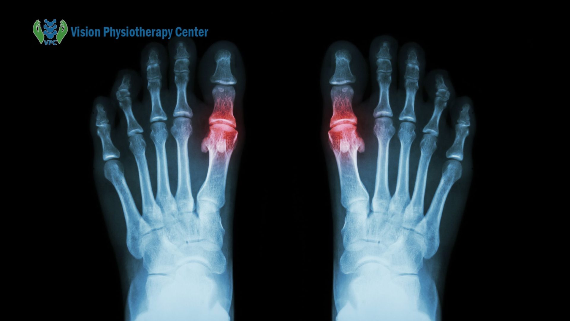 What is early rheumatoid arthritis treatment, What is rheumatoid arthritis triple therapy, What is rheumatoid arthritis cure, What new in rheumatoid arthritis treatments