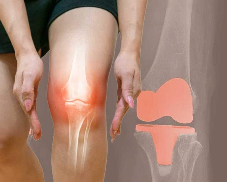 What is the Best Treatment for Osteoarthritis