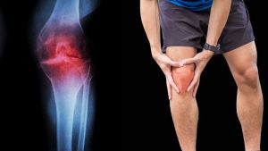 What is the permanent treatment of osteoarthritis