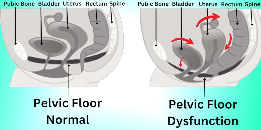 Pelvic floor dysfunction