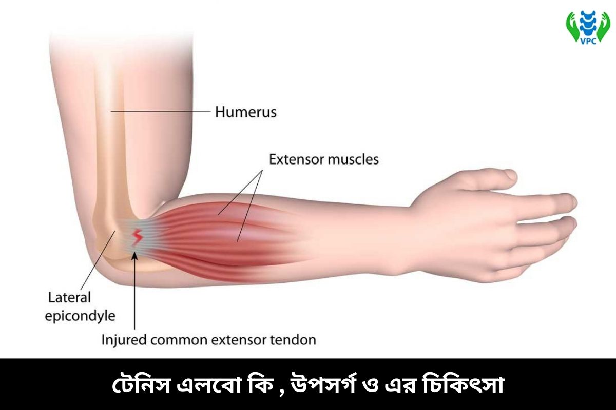 টেনিস এলবো কি , উপসর্গ ও এর চিকিৎসা