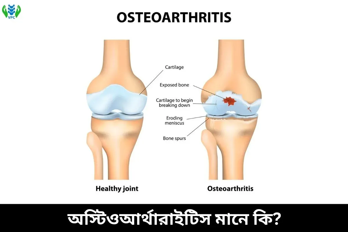 অস্টিওআর্থারাইটিস মানে কি
