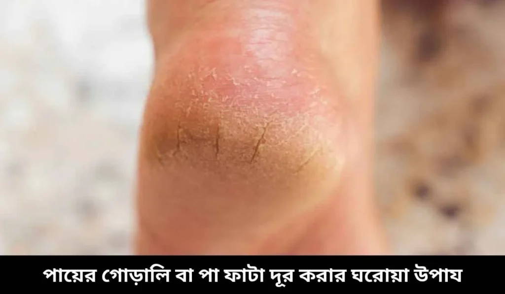 পায়ের গোড়ালি বা পা ফাটা দূর করার ঘরোয়া উপায়