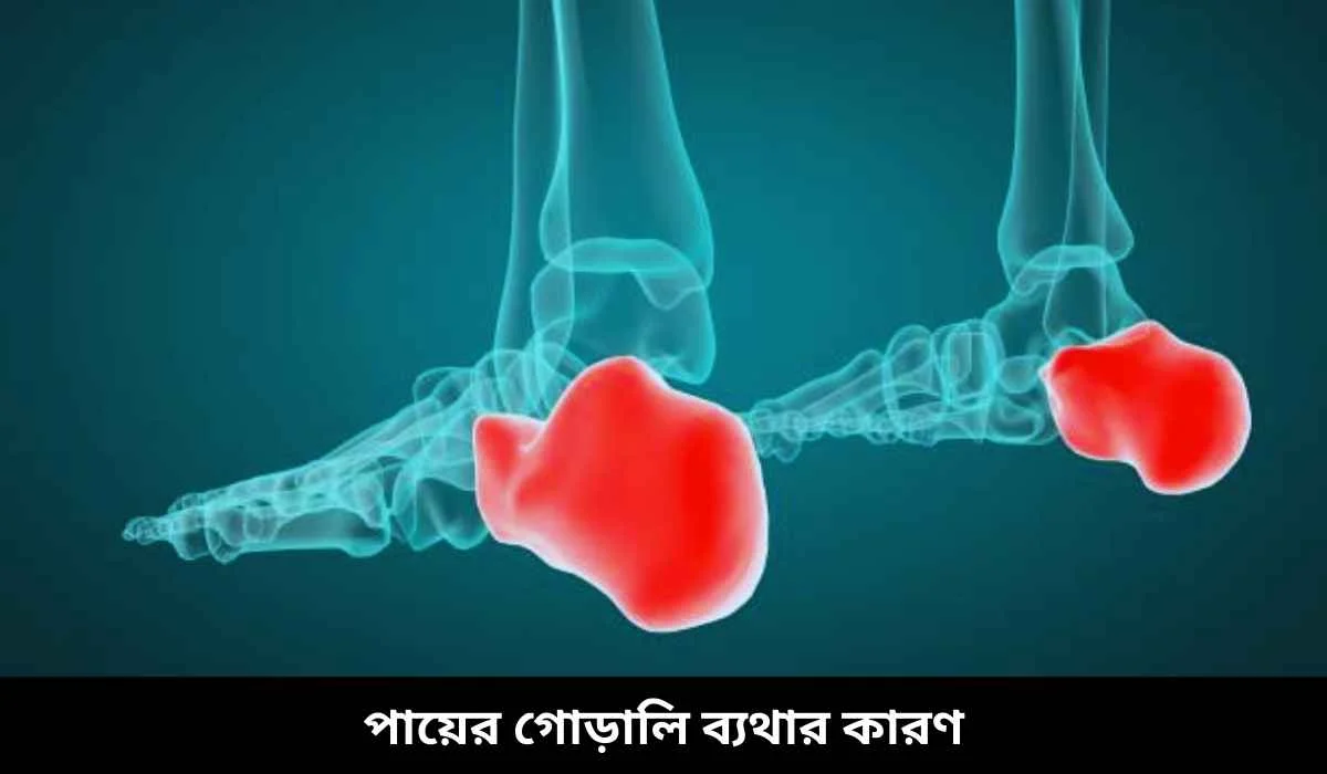 পায়ের গোড়ালি ব্যথার কারণ