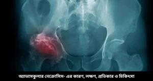 অ্যাভাসকুলার নেক্রোসিস- এর কারণ, লক্ষণ, প্রতিকার ও চিকিৎসা