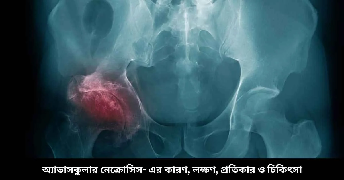 অ্যাভাসকুলার নেক্রোসিস- এর কারণ, লক্ষণ, প্রতিকার ও চিকিৎসা