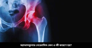 অ্যাভাসকুলার নেক্রোসিস কেন ও কী কারণে হয়