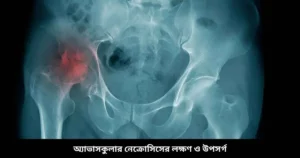 অ্যাভাসকুলার নেক্রোসিসের লক্ষণ ও উপসর্গ